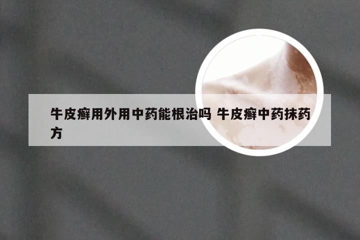 牛皮癣用外用中药能根治吗 牛皮癣中药抹药方