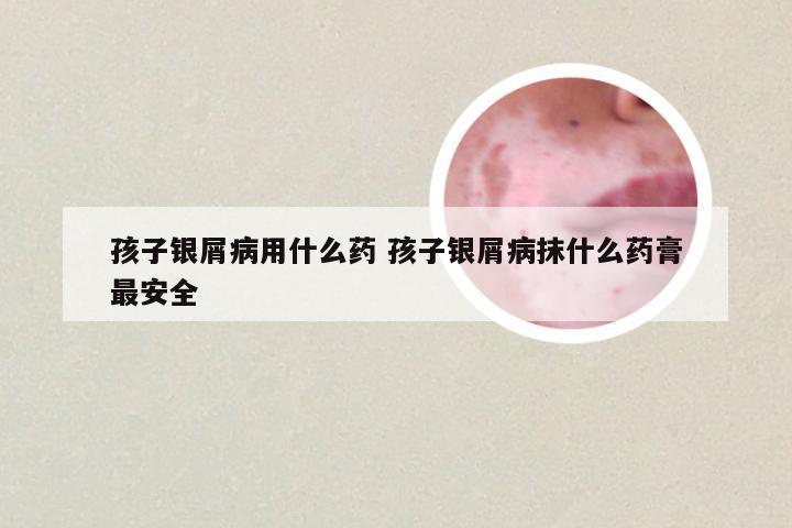 孩子银屑病用什么药 孩子银屑病抹什么药膏最安全