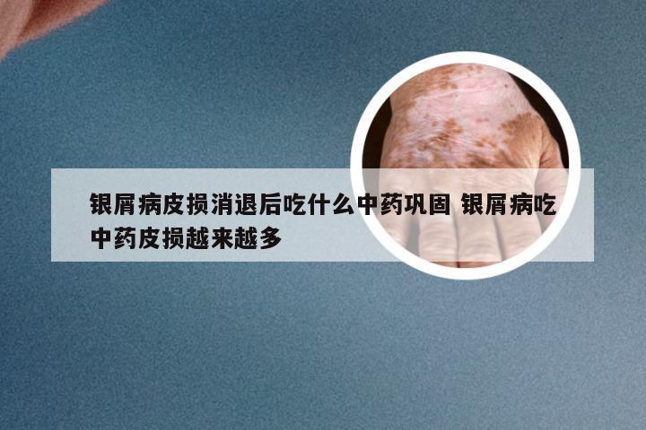 银屑病皮损消退后吃什么中药巩固 银屑病吃中药皮损越来越多