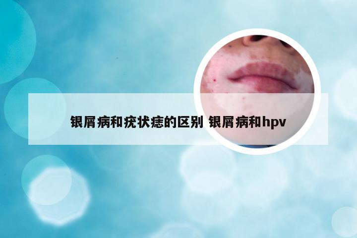 银屑病和疣状痣的区别 银屑病和hpv
