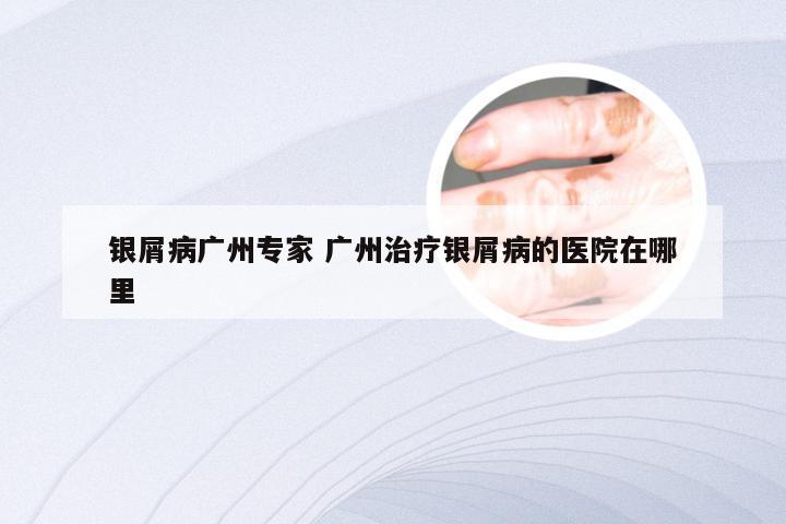 银屑病广州专家 广州治疗银屑病的医院在哪里