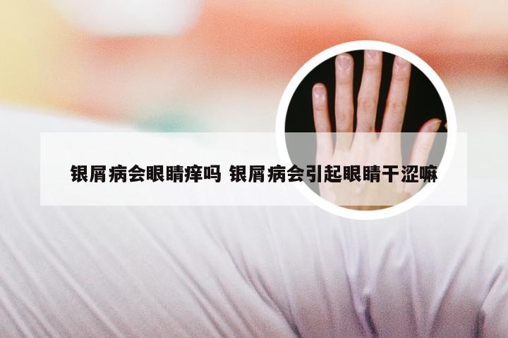 银屑病会眼睛痒吗 银屑病会引起眼睛干涩嘛