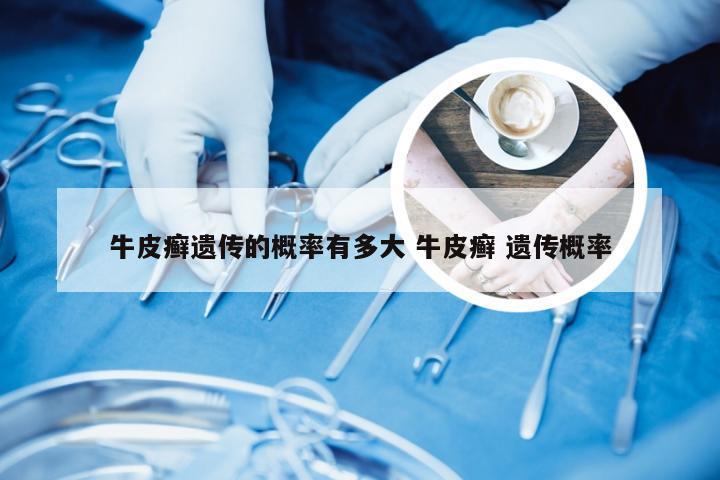 牛皮癣遗传的概率有多大 牛皮癣 遗传概率