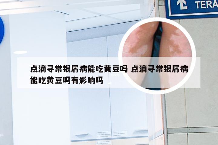 点滴寻常银屑病能吃黄豆吗 点滴寻常银屑病能吃黄豆吗有影响吗