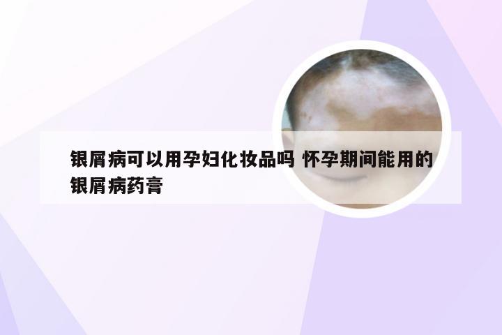 银屑病可以用孕妇化妆品吗 怀孕期间能用的银屑病药膏