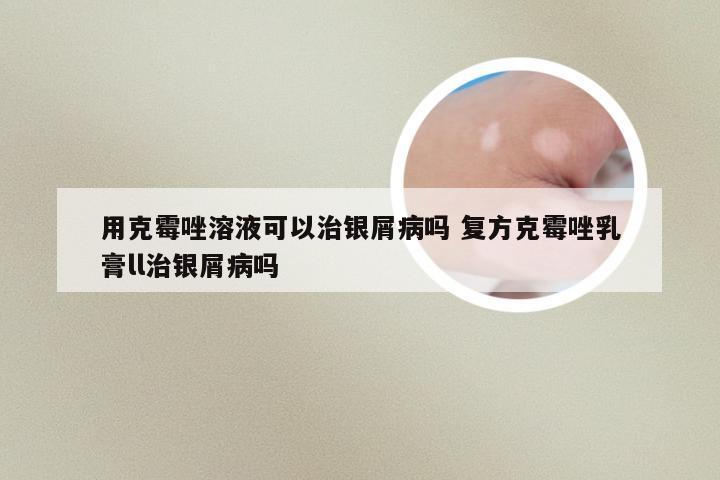 用克霉唑溶液可以治银屑病吗 复方克霉唑乳膏ll治银屑病吗