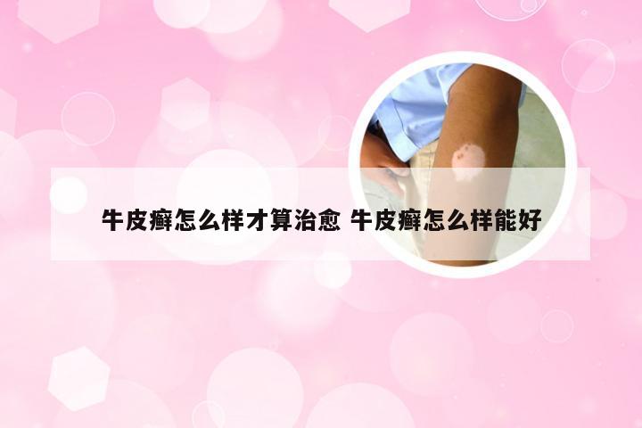 牛皮癣怎么样才算治愈 牛皮癣怎么样能好