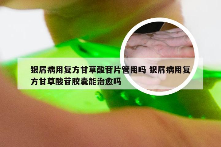 银屑病用复方甘草酸苷片管用吗 银屑病用复方甘草酸苷胶囊能治愈吗