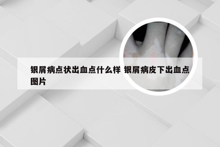 银屑病点状出血点什么样 银屑病皮下出血点图片