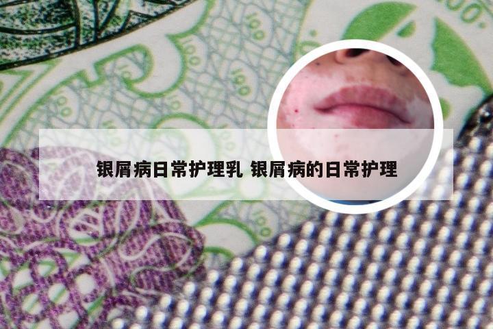 银屑病日常护理乳 银屑病的日常护理