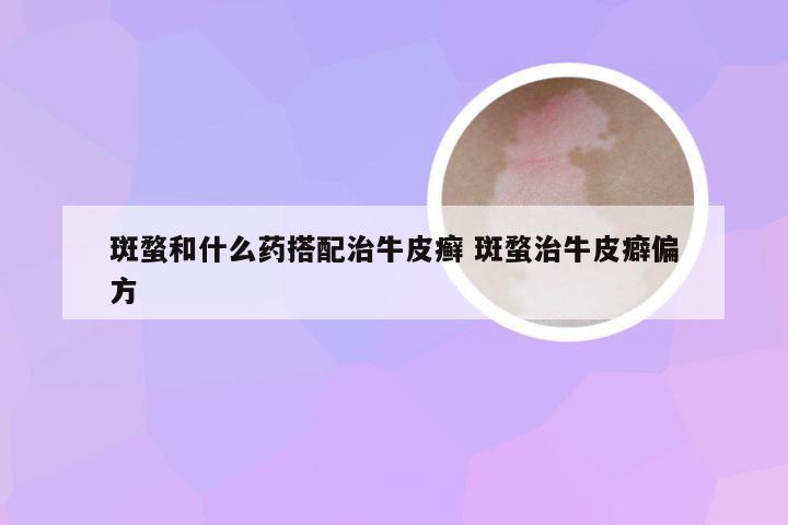 斑蝥和什么药搭配治牛皮癣 斑蝥治牛皮癖偏方