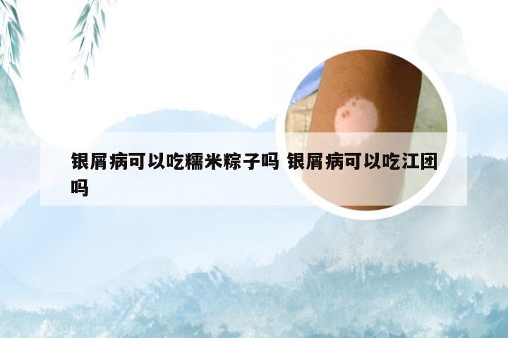 银屑病可以吃糯米粽子吗 银屑病可以吃江团吗