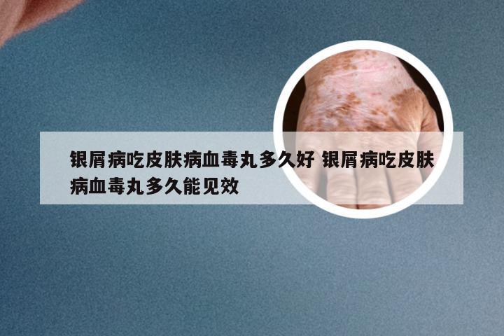 银屑病吃皮肤病血毒丸多久好 银屑病吃皮肤病血毒丸多久能见效