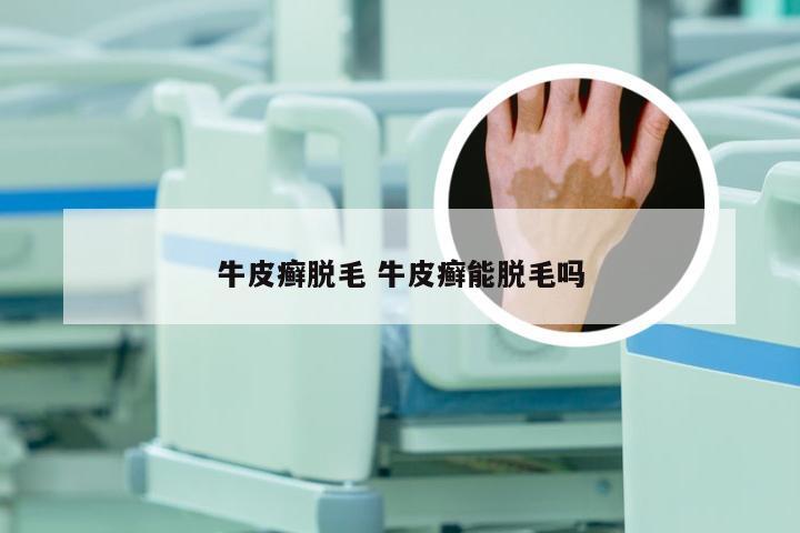 牛皮癣脱毛 牛皮癣能脱毛吗