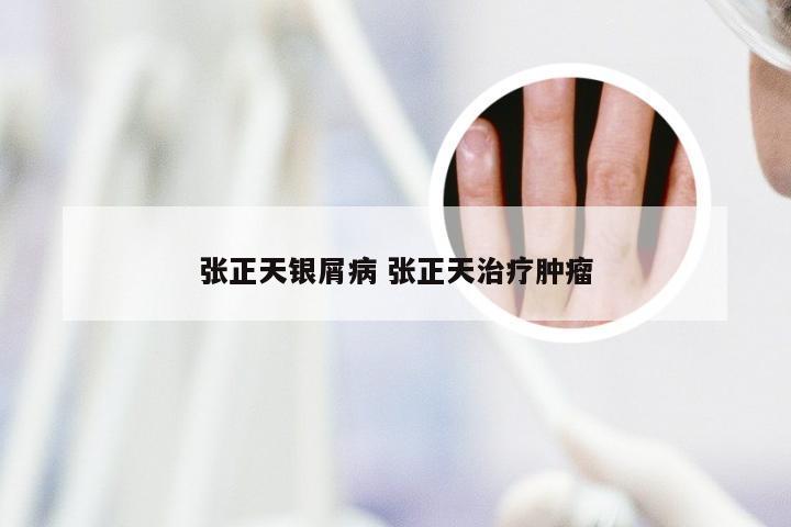 张正天银屑病 张正天治疗肿瘤