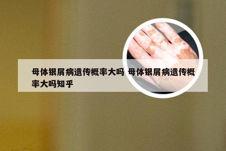 母体银屑病遗传概率大吗 母体银屑病遗传概率大吗知乎