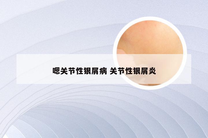 嗯关节性银屑病 关节性银屑炎