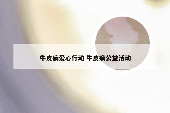 牛皮癣爱心行动 牛皮癣公益活动