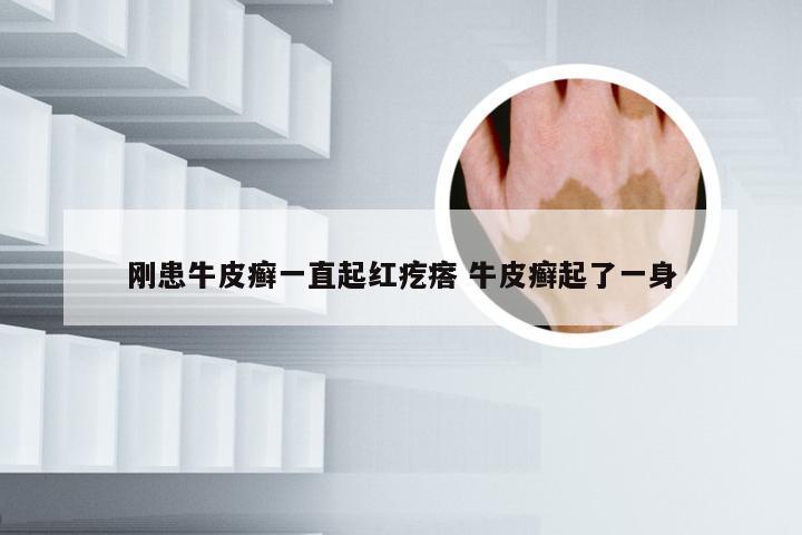 刚患牛皮癣一直起红疙瘩 牛皮癣起了一身