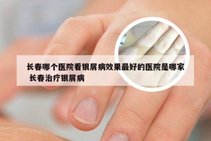 长春哪个医院看银屑病效果最好的医院是哪家 长春治疗银屑病