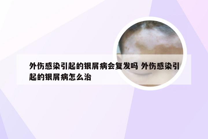 外伤感染引起的银屑病会复发吗 外伤感染引起的银屑病怎么治