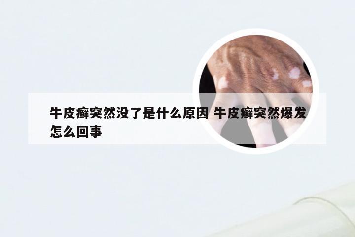 牛皮癣突然没了是什么原因 牛皮癣突然爆发怎么回事