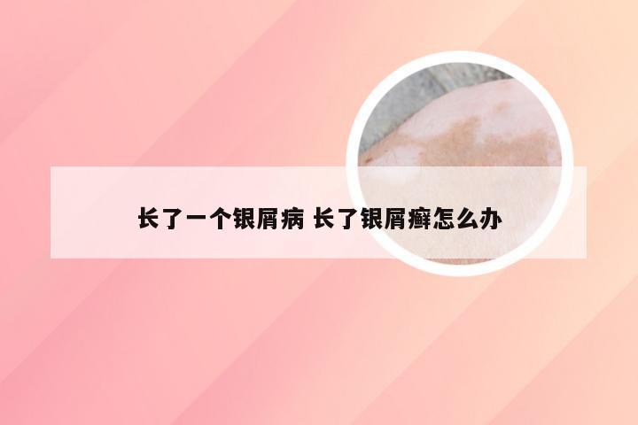 长了一个银屑病 长了银屑癣怎么办