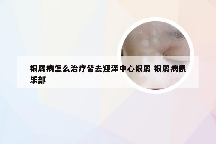 银屑病怎么治疗皆去迎泽中心银屑 银屑病俱乐部