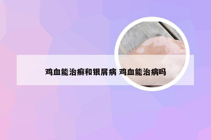鸡血能治癣和银屑病 鸡血能治病吗