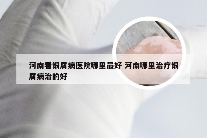 河南看银屑病医院哪里最好 河南哪里治疗银屑病治的好