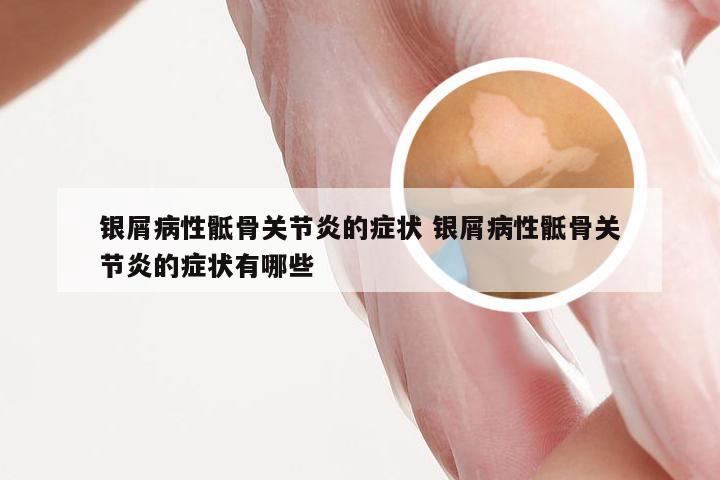 银屑病性骶骨关节炎的症状 银屑病性骶骨关节炎的症状有哪些