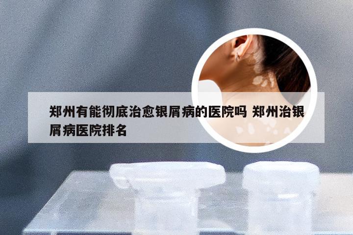 郑州有能彻底治愈银屑病的医院吗 郑州治银屑病医院排名