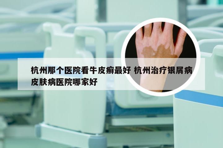 杭州那个医院看牛皮癣最好 杭州治疗银屑病皮肤病医院哪家好