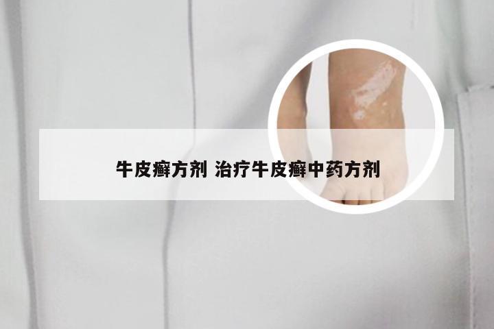 牛皮癣方剂 治疗牛皮癣中药方剂
