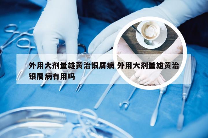 外用大剂量雄黄治银屑病 外用大剂量雄黄治银屑病有用吗