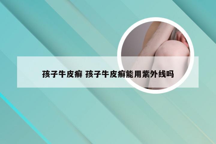 孩子牛皮癣 孩子牛皮癣能用紫外线吗