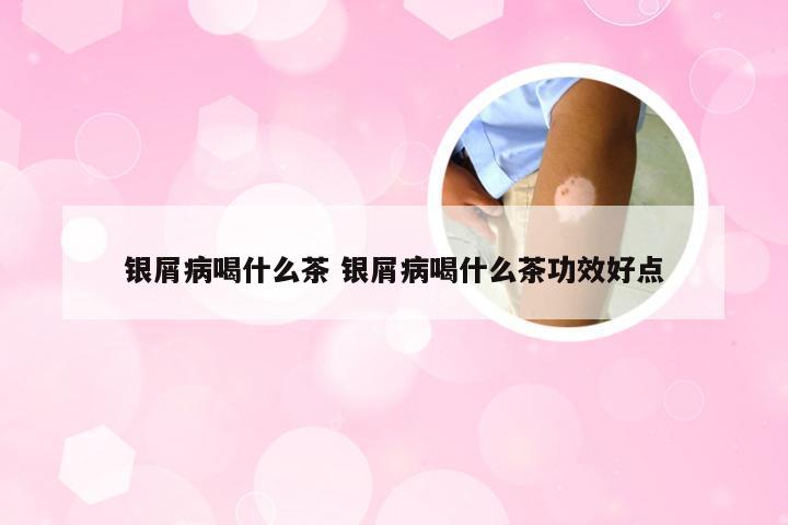 银屑病喝什么茶 银屑病喝什么茶功效好点