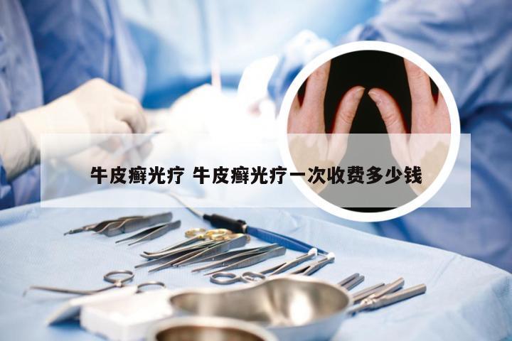 牛皮癣光疗 牛皮癣光疗一次收费多少钱