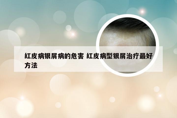 红皮病银屑病的危害 红皮病型银屑治疗最好方法