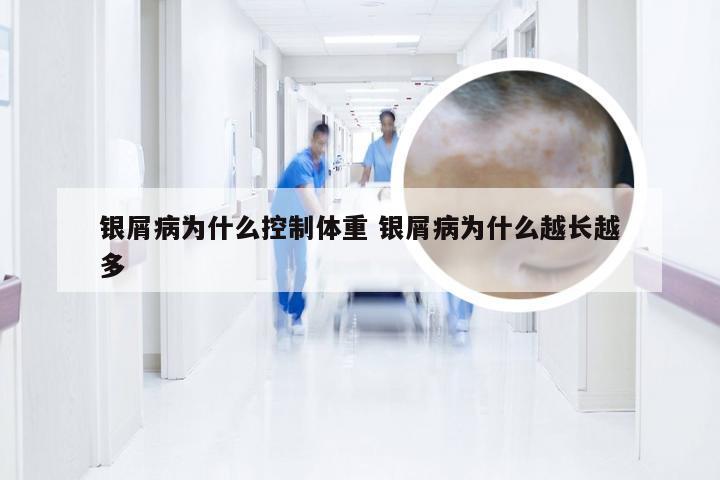 银屑病为什么控制体重 银屑病为什么越长越多