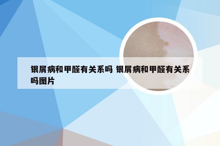 银屑病和甲醛有关系吗 银屑病和甲醛有关系吗图片