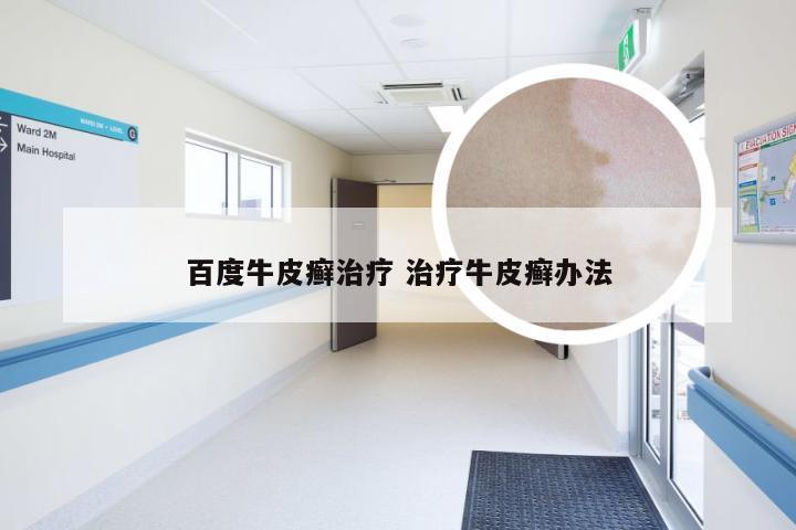 百度牛皮癣治疗 治疗牛皮癣办法