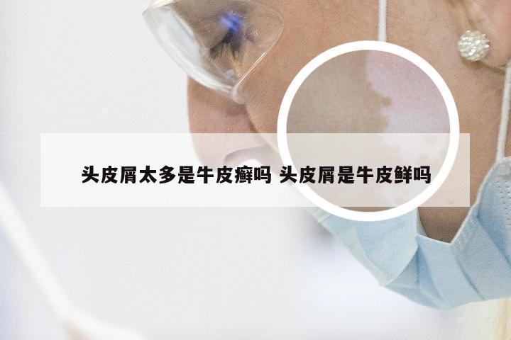 头皮屑太多是牛皮癣吗 头皮屑是牛皮鲜吗