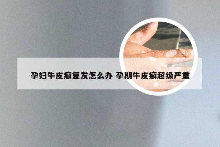 孕妇牛皮癣复发怎么办 孕期牛皮癣超级严重