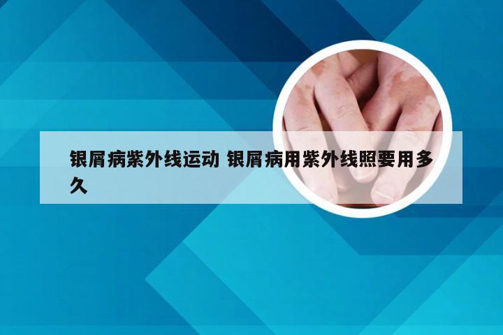 银屑病紫外线运动 银屑病用紫外线照要用多久