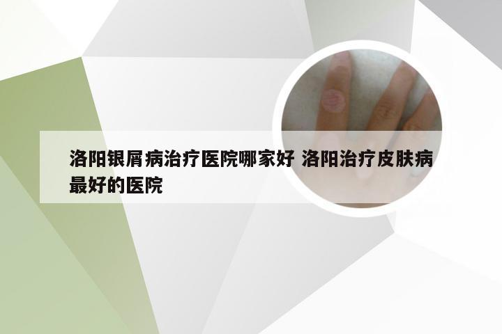 洛阳银屑病治疗医院哪家好 洛阳治疗皮肤病最好的医院