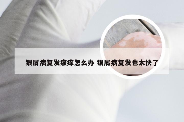 银屑病复发瘙痒怎么办 银屑病复发也太快了