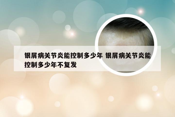 银屑病关节炎能控制多少年 银屑病关节炎能控制多少年不复发