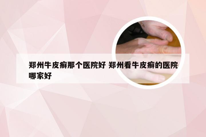 郑州牛皮癣那个医院好 郑州看牛皮癣的医院哪家好