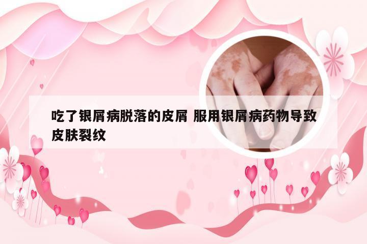 吃了银屑病脱落的皮屑 服用银屑病药物导致皮肤裂纹